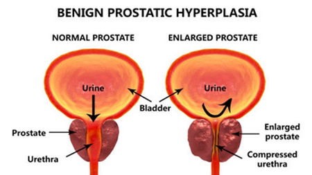 symptoms of benign prostatic hyperplasia