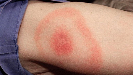 Lyme disease tick rash