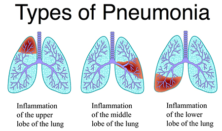types of pneumonia