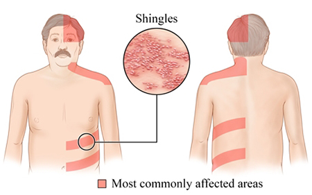 symptoms of shingles (zoster)