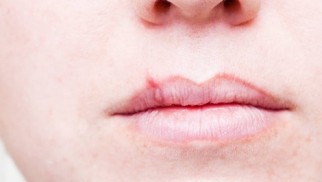 What causes cold sores and how are they treated?