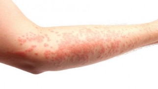 What is urticaria and how is it treated?