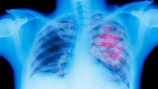 What is lung emphysema and how is it treated?
