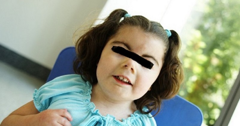 Cornelia de Lange syndrome - causes, symptoms and treatment