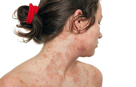 atopic dermatitis causes