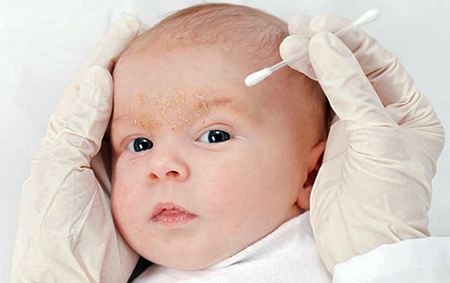 seborrheic dermatitis causes