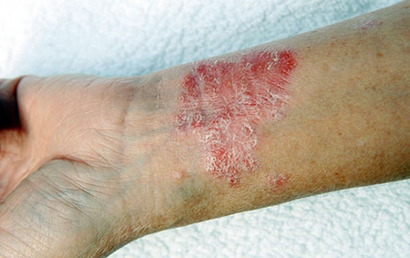 eczema causes