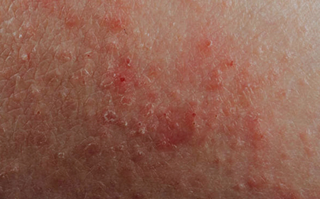 photodermatosis causes and treatment