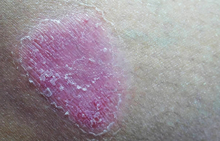 psoriasis causes and treatment