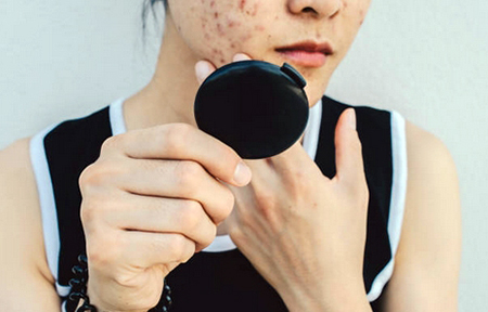 acne causes and treatment