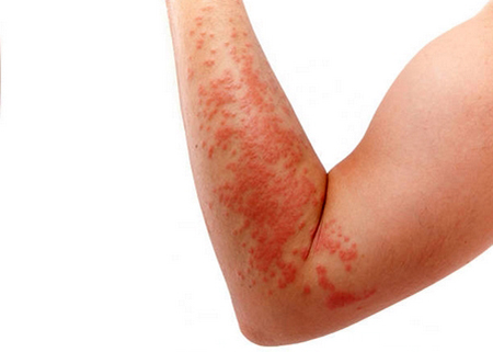 skin rash diseases