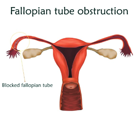 fallopian tubes infertility