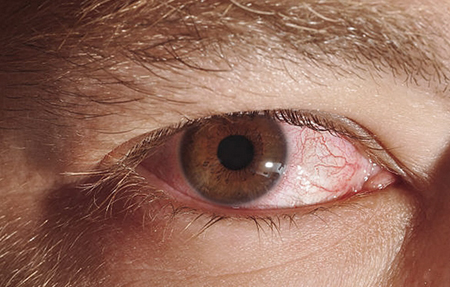 allergic conjuctivitis symptoms