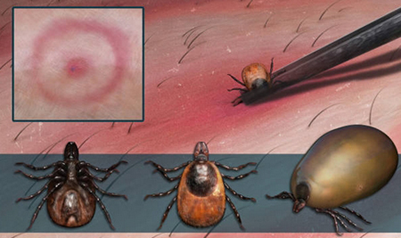 symptoms of Lyme disease