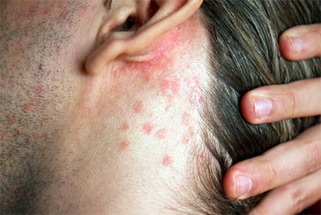 neurodermatitis diagnosis