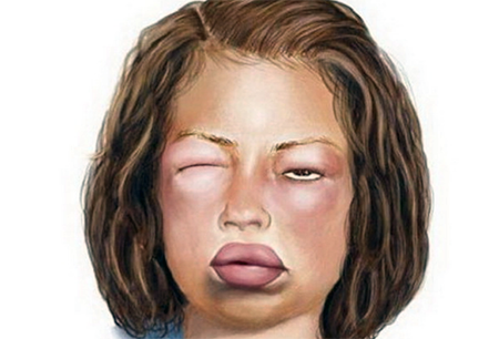 Quincke edema symptoms