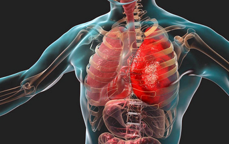 types of chronic bronchitis