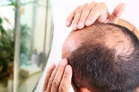 Male Pattern Hair Loss: Causes, Effects, and Solutions