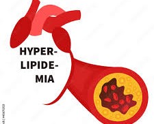 Understanding and Managing Hyperlipidemia: A Comprehensive Guide Understanding and Managing Hyperlipidemia: A Comprehensive Guide