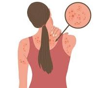 Itching Dermatitis: Causes, Symptoms, and Solutions Itching Dermatitis: Causes, Symptoms, and Solutions