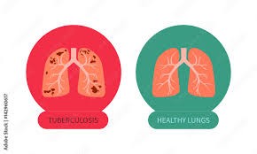 Understanding and Managing Tuberculosis: A Complete Guide