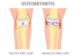 Easing the Burden  Symptomatic Treatment of Osteoarthritis