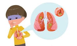 Pneumonia Explained: Understanding, Preventing, and Treating Lung Infections