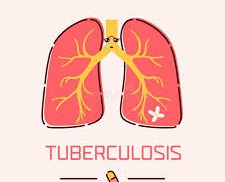 Understanding and Treating Tuberculosis Effectively Understanding and Treating Tuberculosis Effectively
