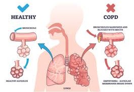 Breathing Forward: Understanding and Managing Chronic Obstructive Pulmonary Disease