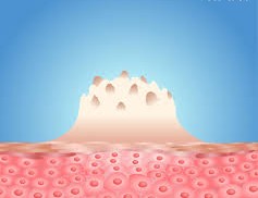 Understanding External Genital Warts