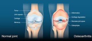 Understanding Inflammatory and Degenerative Diseases