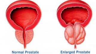 When is Flomax used?