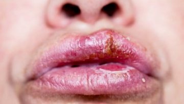 Generic Valtrex Overview for Patients