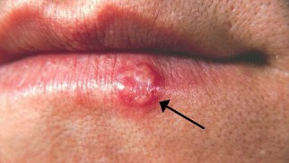 Do you know what herpes is and how is it treated? Do you know what herpes is and how is it treated?