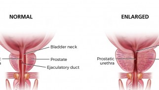 Are you at risk of benign prostatic hyperplasia development? Are you at risk of benign prostatic hyperplasia development?