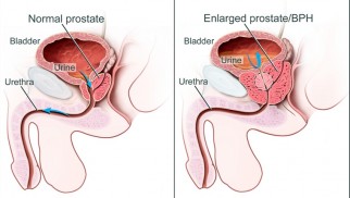 Prophylaxis, prevention, and treatment of benign prostatic hyperplasia Prophylaxis, prevention, and treatment of benign prostatic hyperplasia