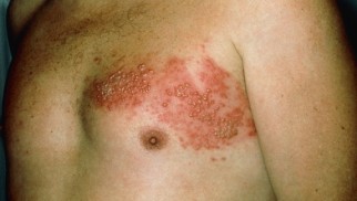 What is shingles and how is it treated?