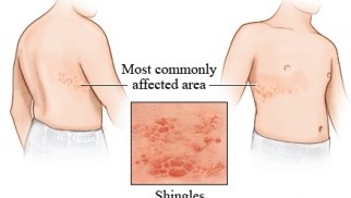 What is shingles and how is it treated?