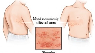 What is shingles and how is it treated?