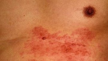 Shingles diagnosis and treatment