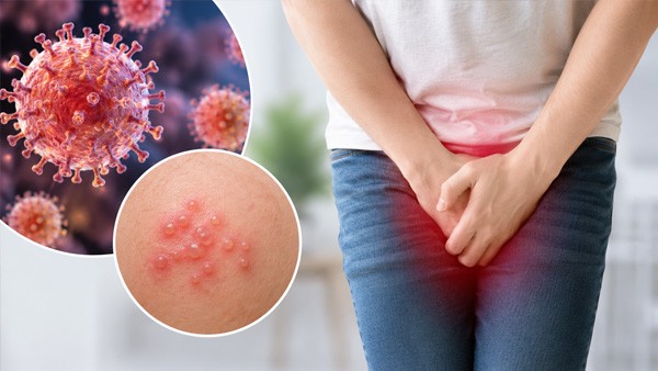 Genital Herpes: Diagnosis, Treatment and Transmission