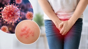 Genital Herpes: Diagnosis, Treatment and Transmission