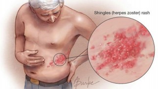 Who is at risk of developing shingles and how is it treated?