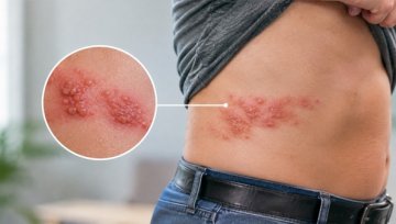 Shingles: The 72-Hour Window and the Nerve Pain After