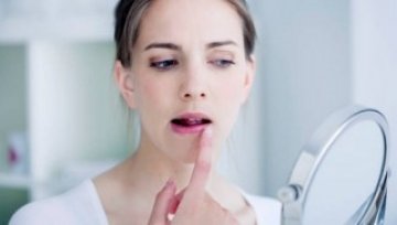What causes cold sores and how are they treated?