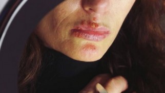 What is herpes and how is it treated? What is herpes and how is it treated?