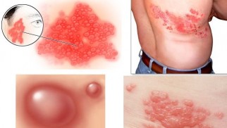 What is herpes zoster and does it require treatment or not?