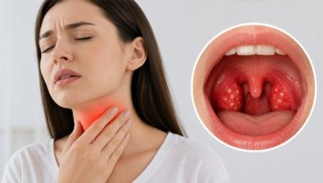 Pharyngitis: Why Most Sore Throats Need No Antibiotic