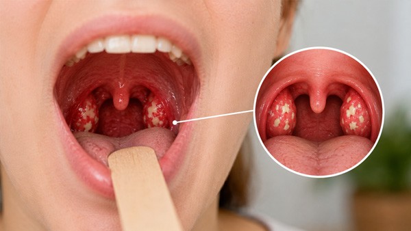 Tonsillitis: Why It Returns and When Tonsils Come Out Tonsillitis: Why It Returns and When Tonsils Come Out