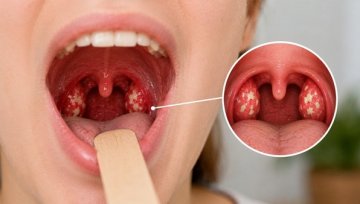 Tonsillitis: Why It Returns and When Tonsils Come Out